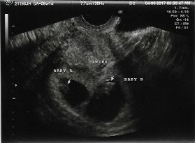 8 week ultrasound 3d twins